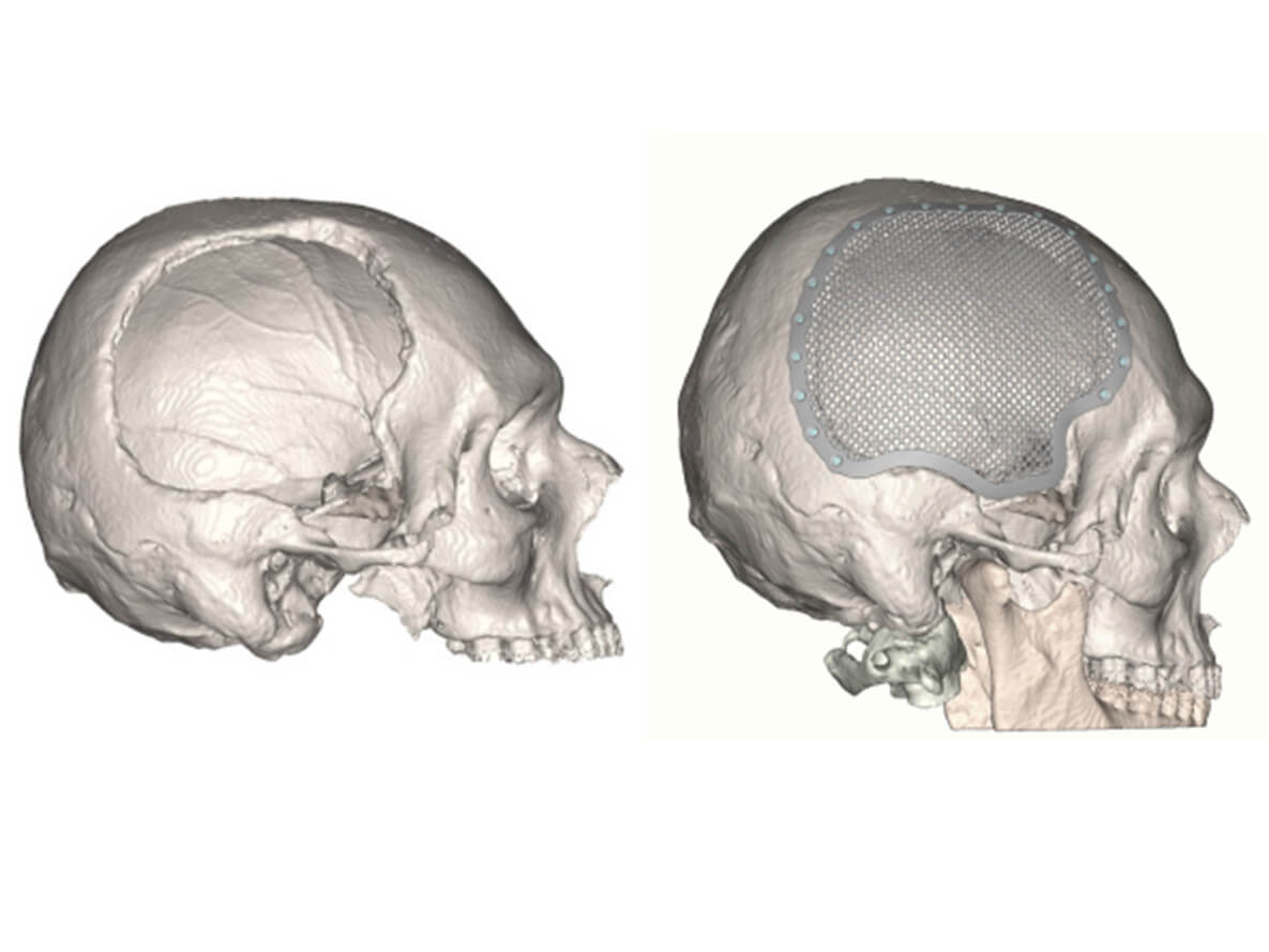 Knochenimplantate für Verwundete finanziert