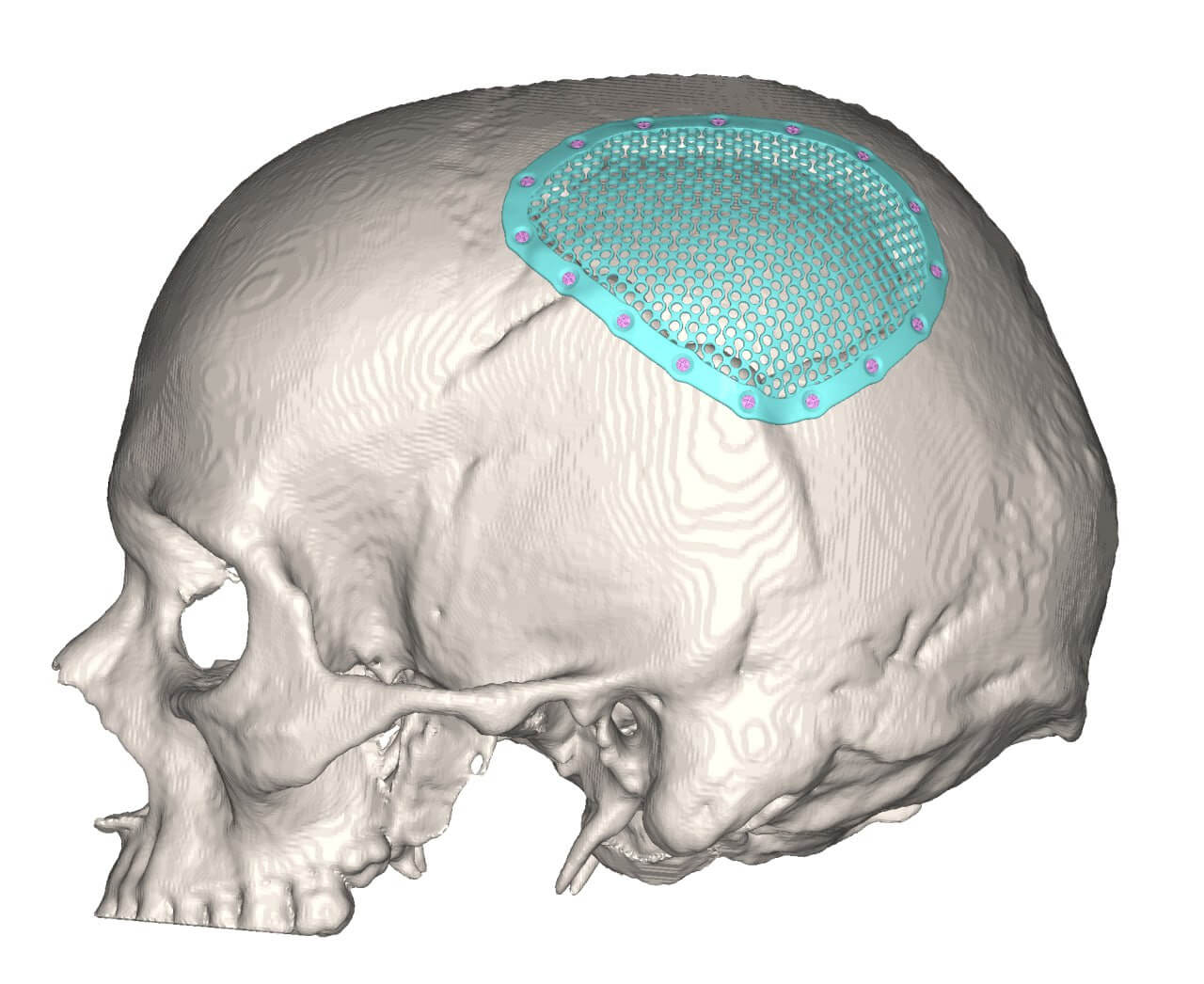 Medizinische Hilfe mit 3D-Implantaten für Schwerverletzte