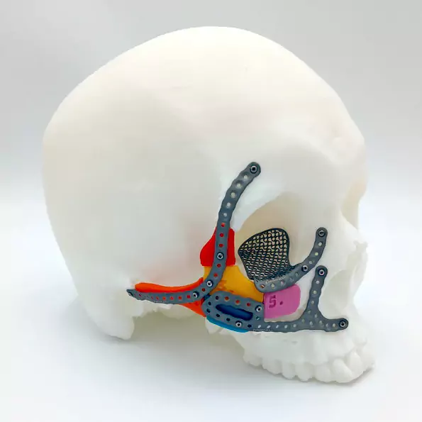 3D-Druck-Implantate: Hilfe für Verwundete
